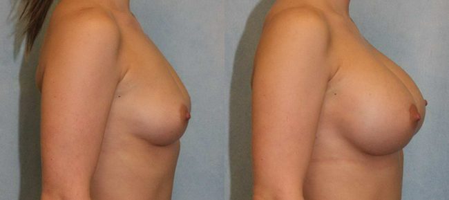 Breast Augmentation Patient 10 Image 2