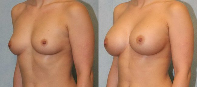 Breast Augmentation Patient 10 Image 1