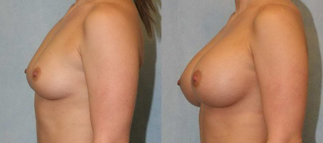 Breast Augmentation Patient 10 Image 0