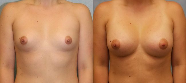 Breast Augmentation Patient 18 Image 3