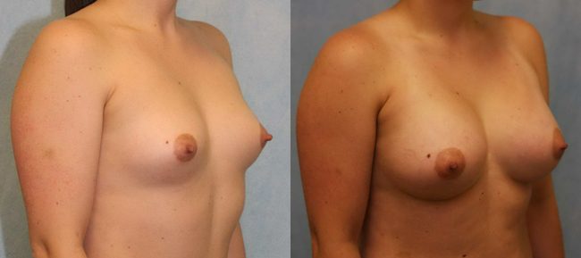 Breast Augmentation Patient 1460 Image 2