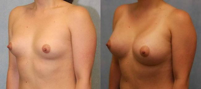 Breast Augmentation Patient 18 Image 1