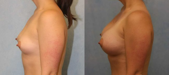 Breast Augmentation Patient 18 Image 0