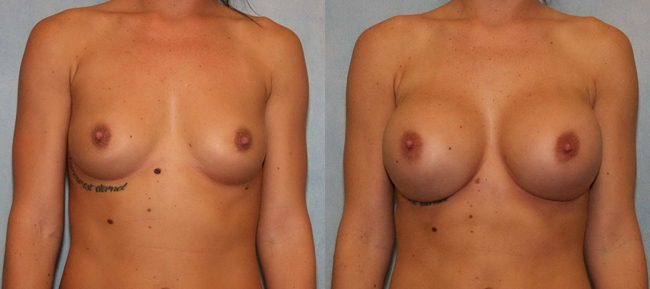 Breast Augmentation Patient 19 Image 4