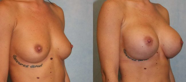 Breast Augmentation Patient 19 Image 3