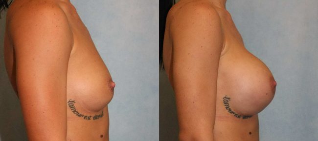 Breast Augmentation Patient 19 Image 2