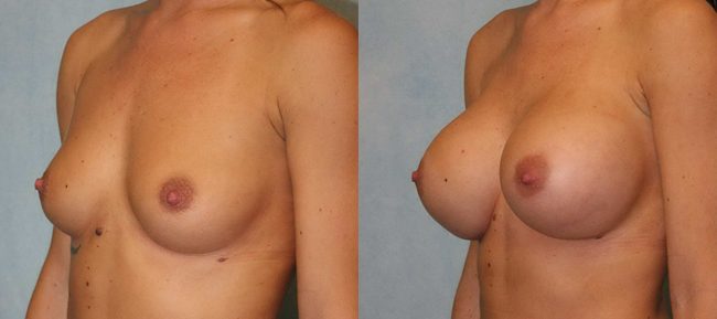 Breast Augmentation Patient 19 Image 1