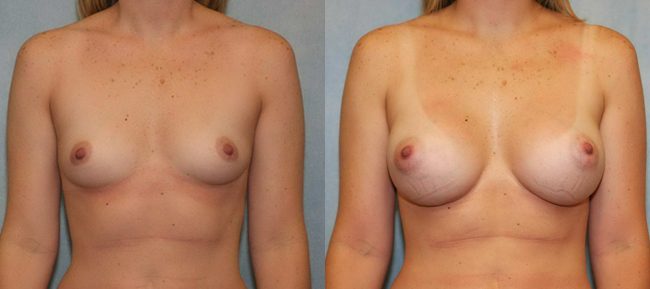 Breast Augmentation Patient 1498 Image 4