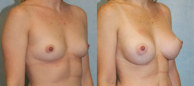 Breast Augmentation Patient 16 Image 3