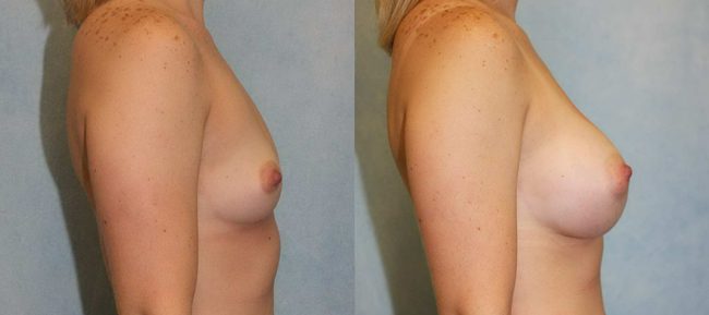 Breast Augmentation Patient 16 Image 2