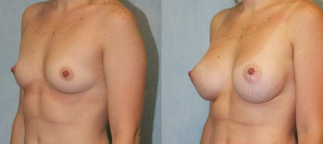 Breast Augmentation Patient 16 Image 1