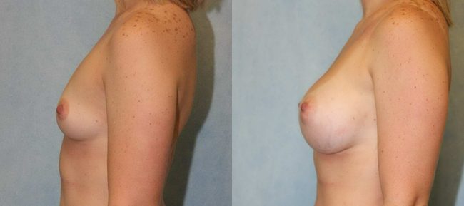 Breast Augmentation Patient 16 Image 0