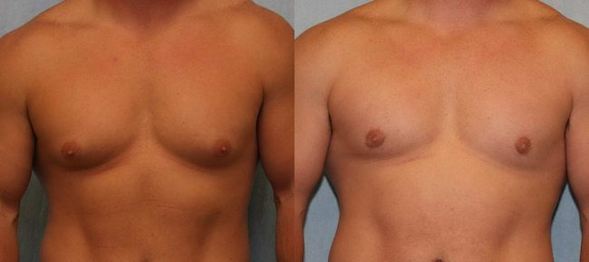 Male Gynecomastia Patient 5 Image 4