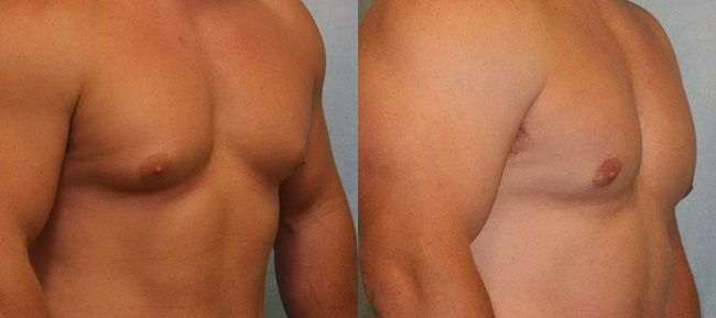 Male Gynecomastia Patient 5 Image 3