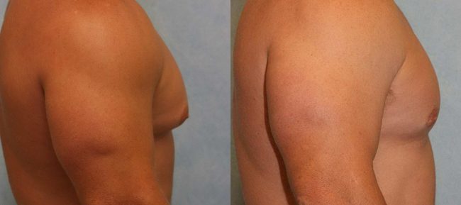 Male Gynecomastia Patient 5 Image 2