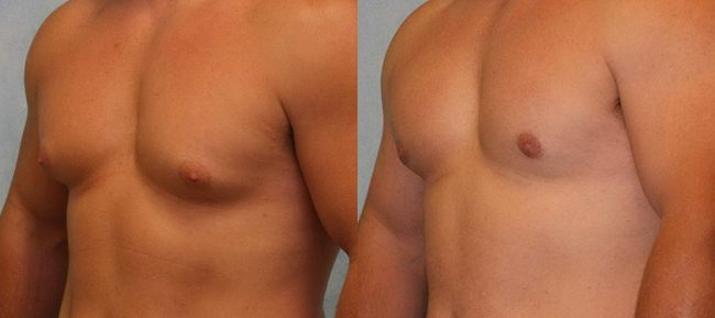 Male Gynecomastia Patient 5 Image 1