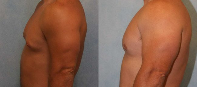 Male Gynecomastia Patient 5 Image 0