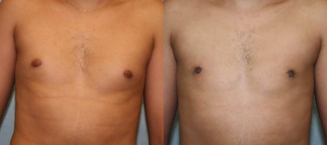 Male Gynecomastia Patient 4 Image 4