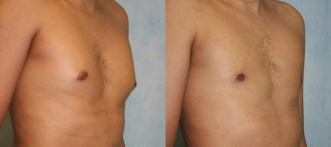 Male Gynecomastia Patient 4 Image 3