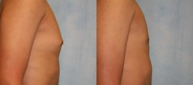 Male Gynecomastia Patient 4 Image 2