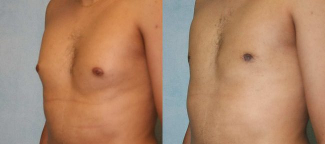 Male Gynecomastia Patient 4 Image 1