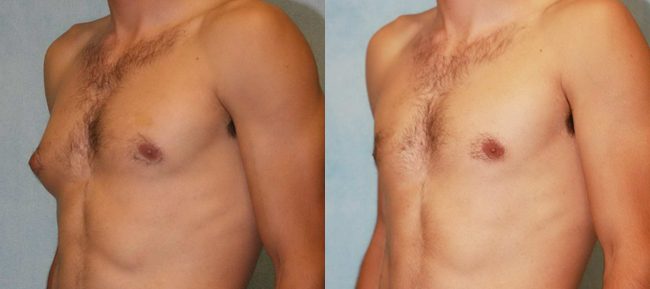 Male Gynecomastia Patient 3 Image 4