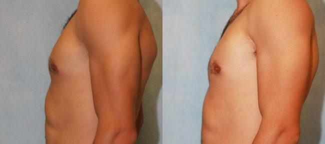 Male Gynecomastia Patient 3 Image 3