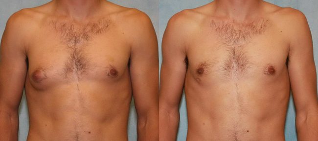 Male Gynecomastia Patient 3 Image 2