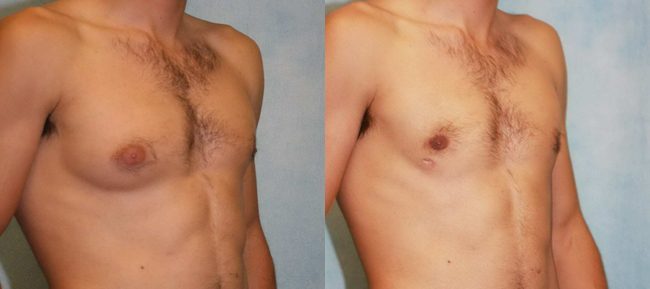 Male Gynecomastia Patient 3 Image 1