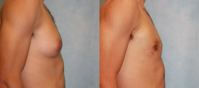 Male Gynecomastia Patient 3 Image 0