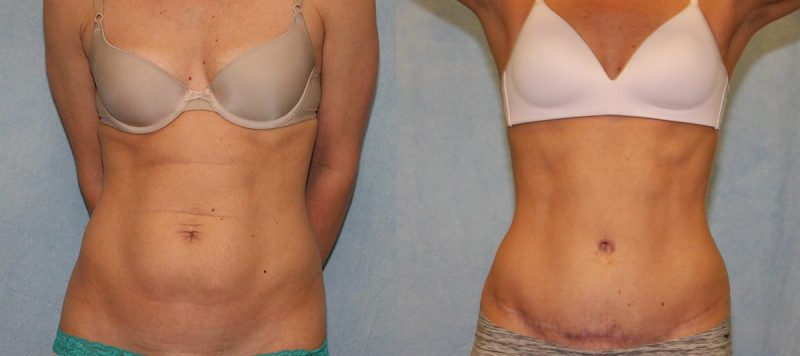 Abdominoplasty Patient 9 Image 3