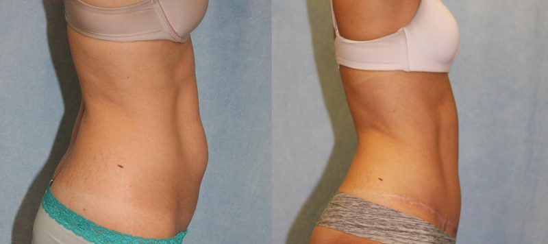 Abdominoplasty Patient 9 Image 2