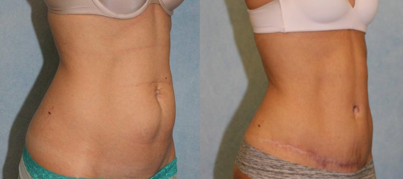 Abdominoplasty Patient 9 Image 1