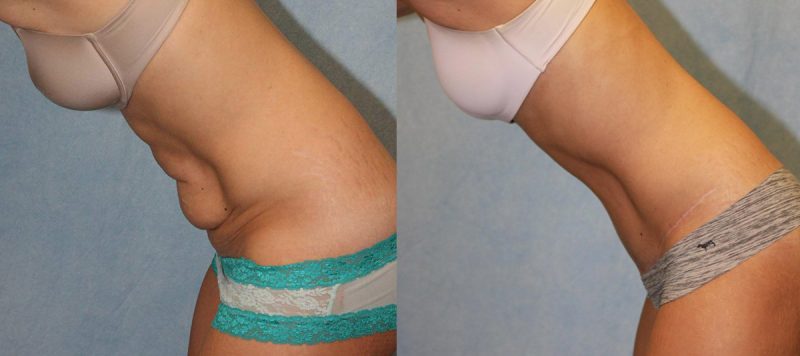 Abdominoplasty Patient 9 Image 0