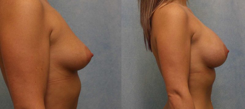 Breast Augmentation Patient 8 Image 2