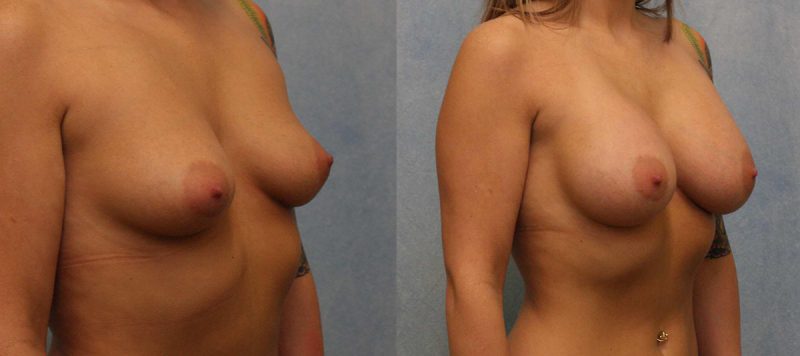 Breast Augmentation Patient 8 Image 1