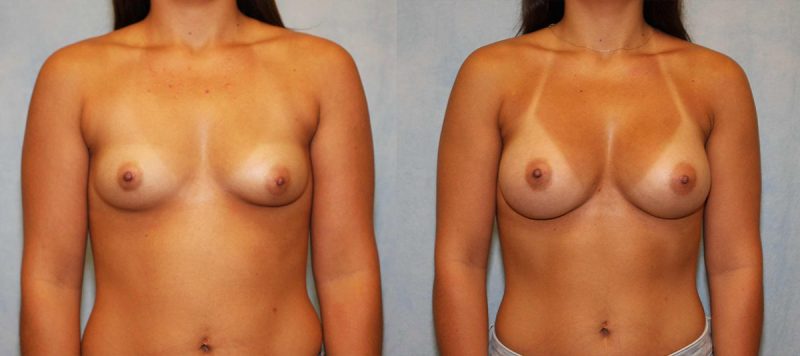 Breast Augmentation Patient 13 Image 3