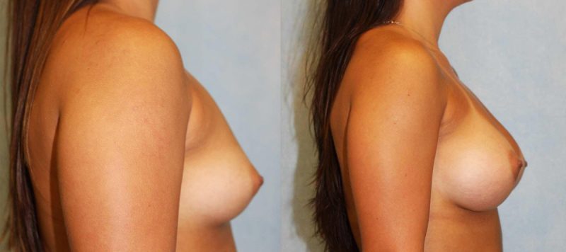 Breast Augmentation Patient 13 Image 4