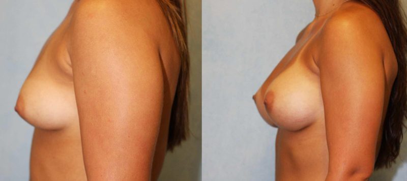 Breast Augmentation Patient 13 Image 1