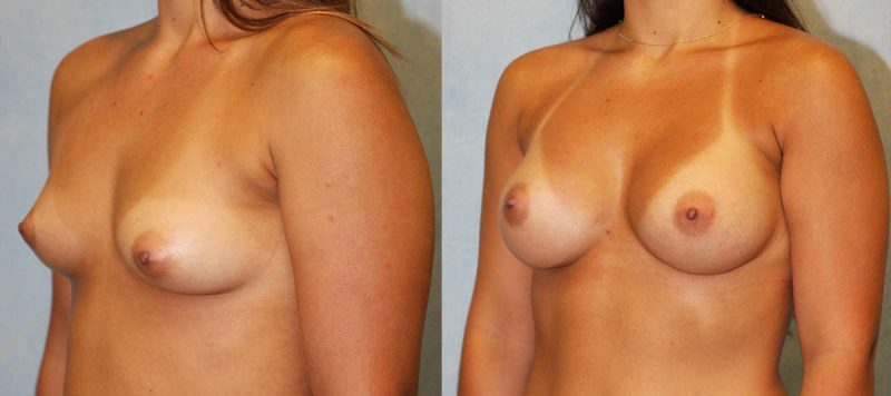 Breast Augmentation Patient 13 Image 0