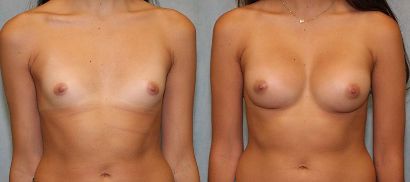Breast Augmentation Patient 22 Image 0