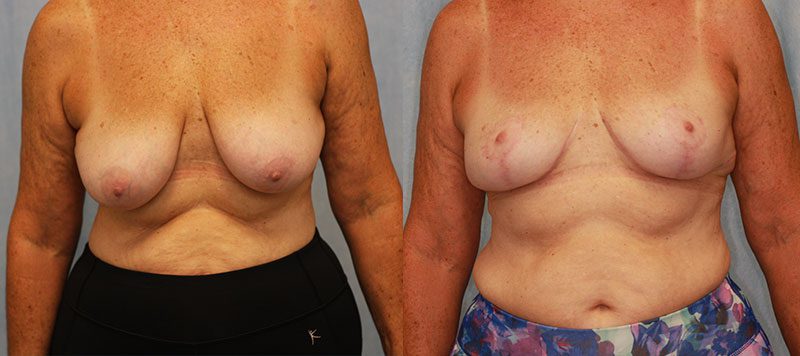 Breast Lift Patient 9 Image 3