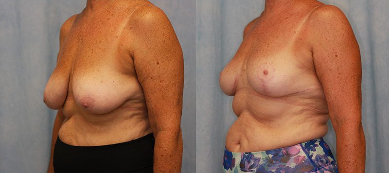 Breast Lift Patient 9 Image 2