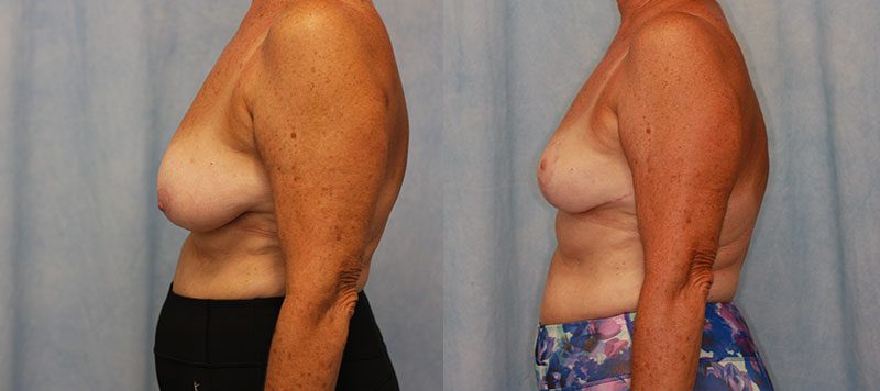 Breast Lift Patient 9 Image 1