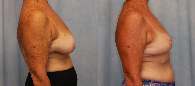 Breast Lift Patient 9 Image 0