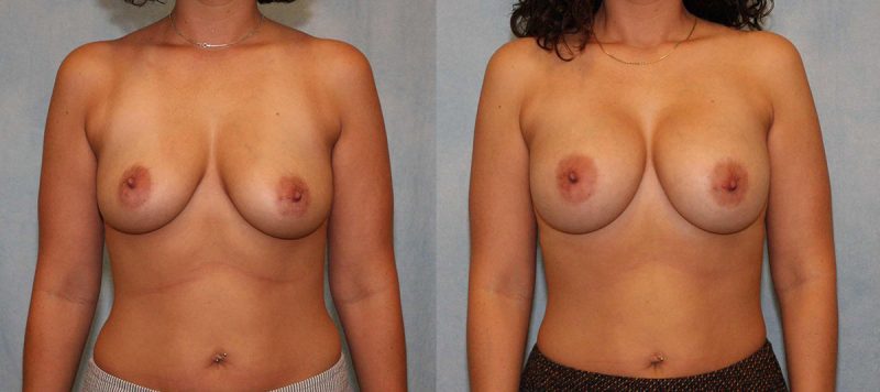 Breast Augmentation Patient 7 Image 4