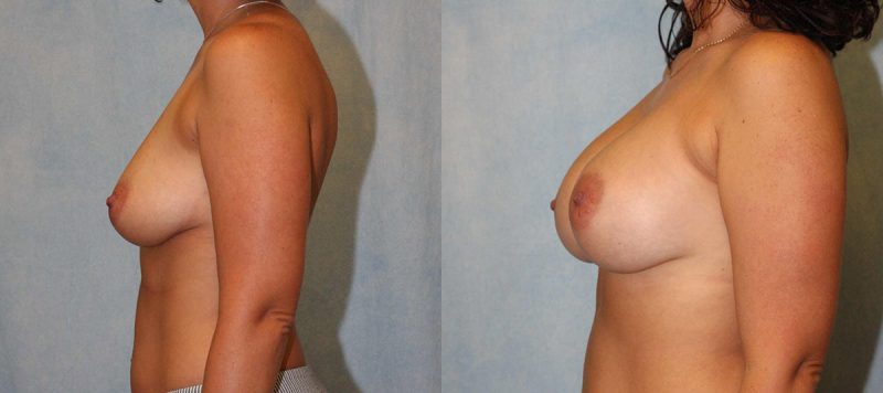 Breast Augmentation Patient 1862 Image 1
