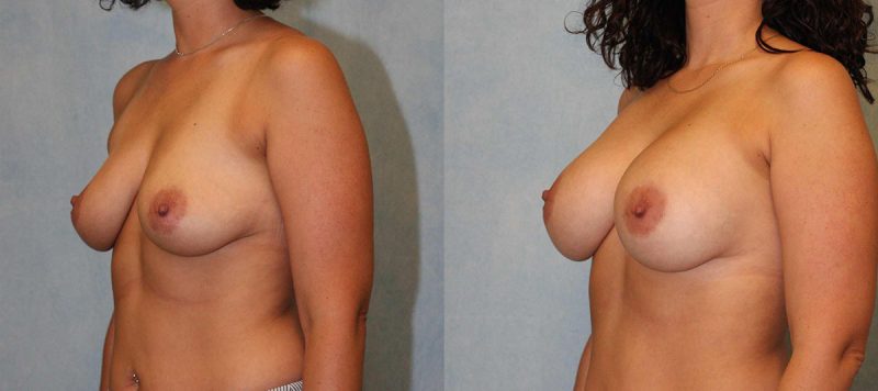 Breast Augmentation Patient 7 Image 0