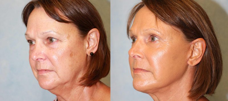 Facelift Patient 9 Image 2