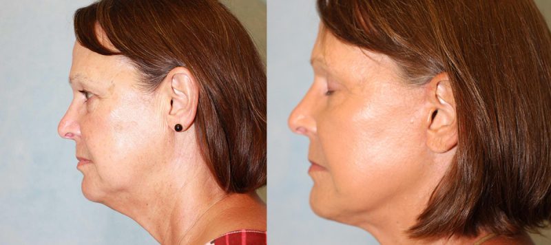 Facelift Patient 9 Image 3